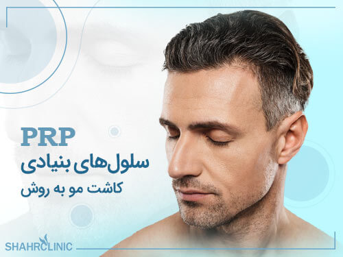 کاشت مو به روش سلول های بنیادی PRP