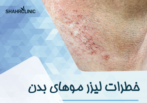 خطرات لیزر موهای بدن