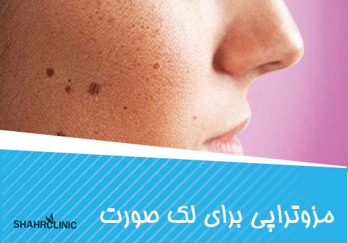 مزوتراپی برای لک صورت