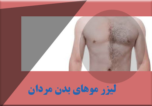 لیزر موهای زائد