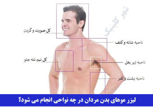 لیزر موهای بدن مردان در چه نواحی از بدن صورت می‌گیرد؟