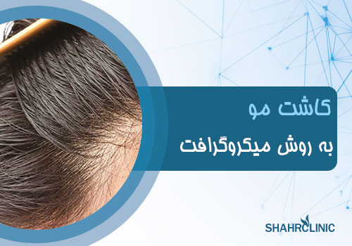 کاشت مو به روش میکروگرافت