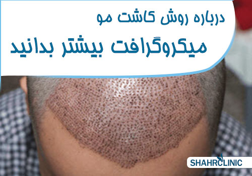 درباره روش میکروگرافت بیشتر بدانید