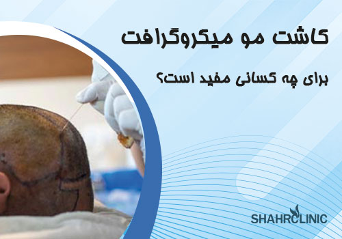 کاشت مو به روش میکروگرافت برای چه کسانی مناسب است؟