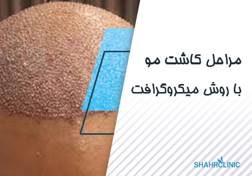 مراحل کاشت مو با روش میکروگرافت