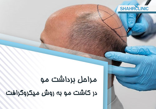 مرحله برداشت مو در کاشت مو به روش میکروگرافت