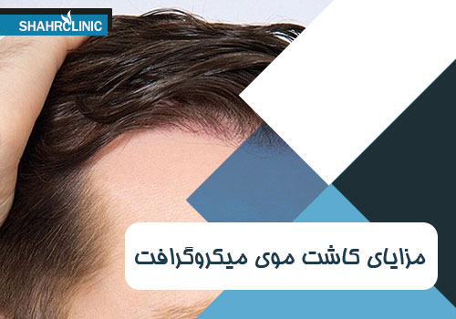 مزایای کاشت موی میکرو گرافت