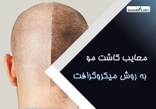 معایب و عوارض احتمالی کاشت موی میکروگرافت