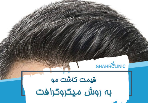 قیمت کاشت مو به روش میکروگرافت