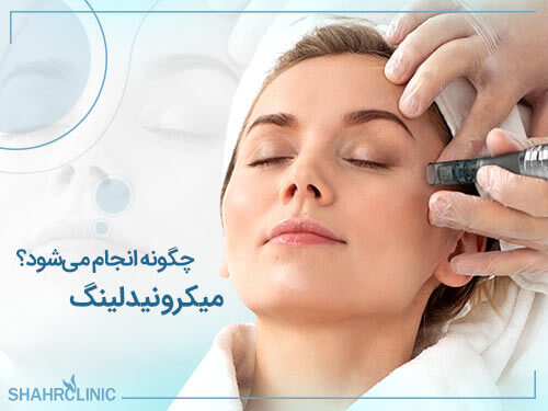 میکرونیدلینگ چگونه انجام می شود؟