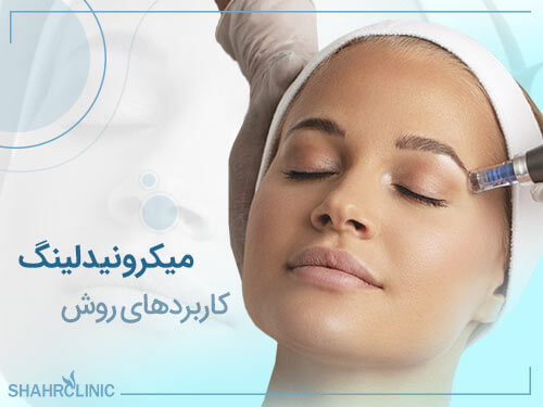 کاربردهای میکرونیدلینگ