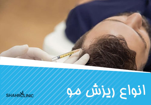 انواع ریزش مو