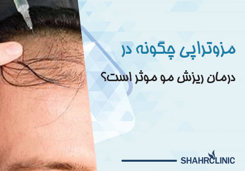  مزوتراپی چگونه در درمان ریزش مو موثر است؟