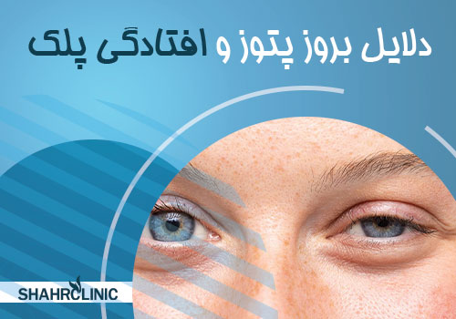 دلایل بروز پتوز و افتادگی پلک