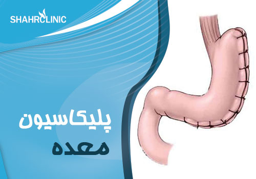 پلیکاسیون معده