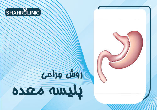 روش جراحی پلیسه معده