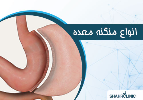 انواع منگنه معده