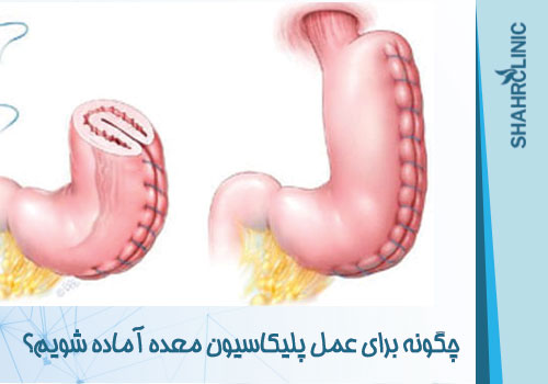چگونه برای عمل پلیکاسیون معده آماده شویم؟