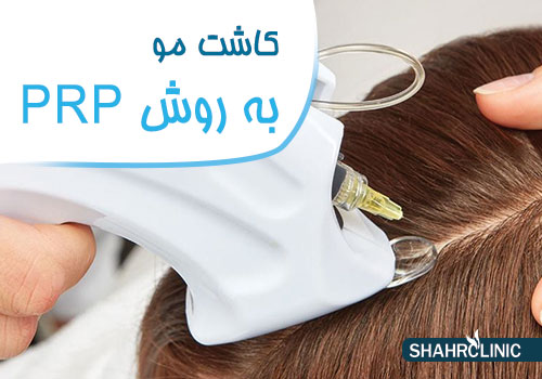 کاشت مو به روش prp