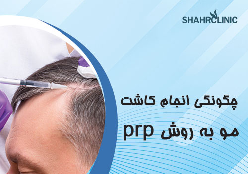 چگونگی انجام کاشت مو به روش PRP