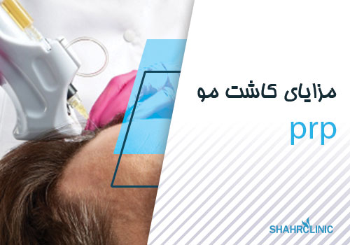 مزایای کاشت مو به روش PRP