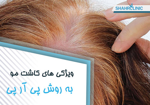 ویژگی های کاشت مو به روش پی آر پی