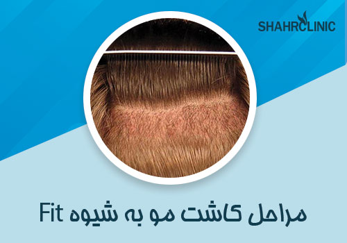 مراحل کاشت مو به روش fit