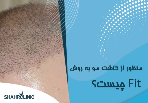 منظور از کاشت مو به روش fit