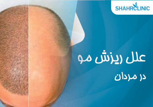 علل ریزش مو در مردان