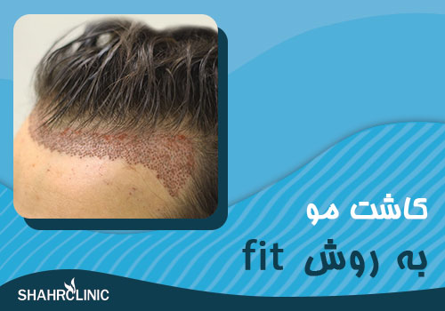 کاشت مو به روش هف