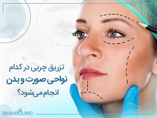 تزریق چربی در کدام نواحی بدن انجام می شود و چه کاربردهایی دارد؟