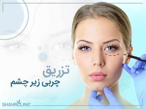 تزریق چربی زیر چشم