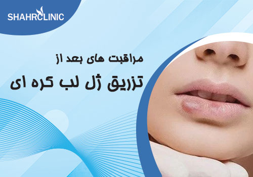 مراقبت های بعد از تزریق ژل لب کره ایی