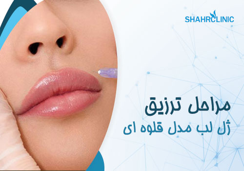 مراحل تزریق ژل لب قلوه ایی