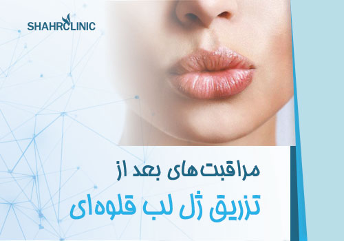 مراقبت های از تزریق ژل لب مدل قلوه ایی