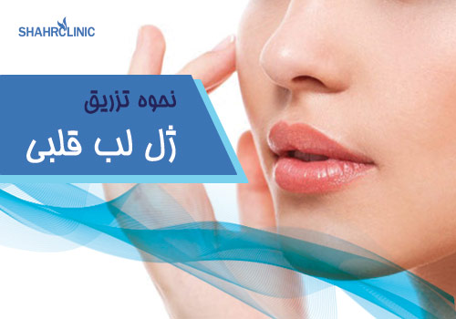 نحوه تزریق ژل لب