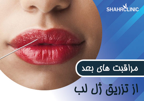 مراقبت های بعد از تزریق ژل