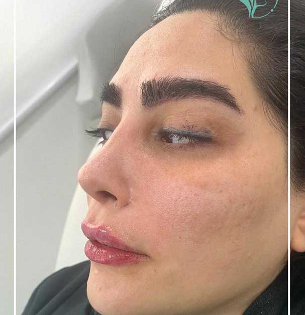 تصویر قیمت تزریق ژل لب 